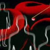 Полицитемия вера, доказване на анемичен синдром, хемоглобин