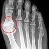 Ендопротези при Hallux rigidus, ставен дебридман хейлектомия, протеза на палеца, лечение на hallux rigidus