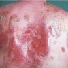 пемфигус вулгарис,автоимунно заболяване на кожата,autoimmune disorders,pemphigus vulgaris treatment, pemphigus vulgaris prognosis,симптомът на Никольский – свличане на епидермиса при натиск върху здрава кожа в близост до активни лезии,автоимунно заболяване на кожата и лигавиците, при което е нарушена връзката между кератиноцитите