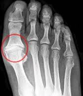 Ендопротези при Hallux rigidus, ставен дебридман хейлектомия, протеза на палеца, лечение на hallux rigidus